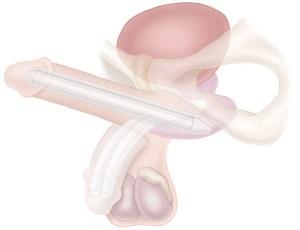 malleable penile implant.
